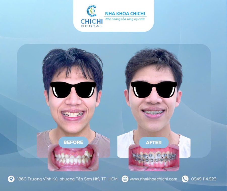 Trước và sau chỉnh nha - Khách hàng 1