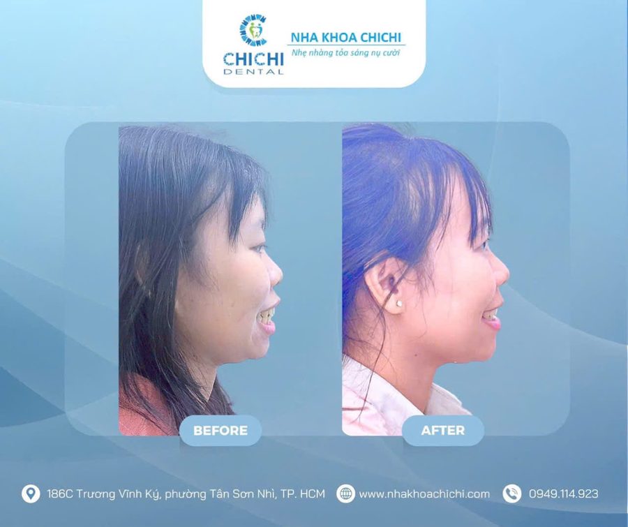 Trước và sau chỉnh nha - Khách hàng 10