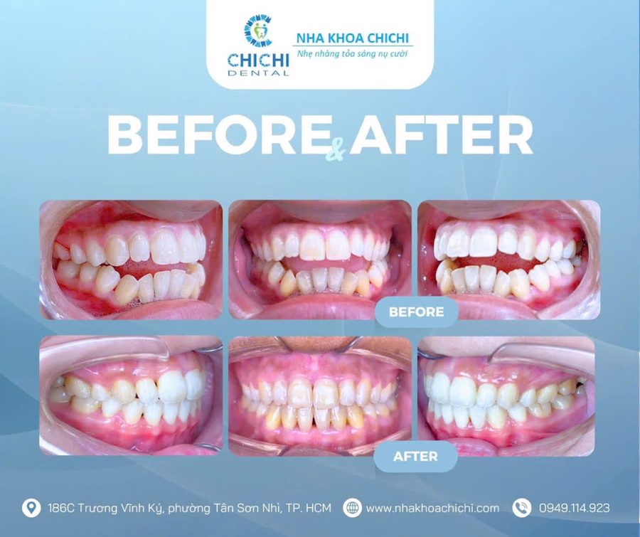 Trước và sau chỉnh nha - Khách hàng 11