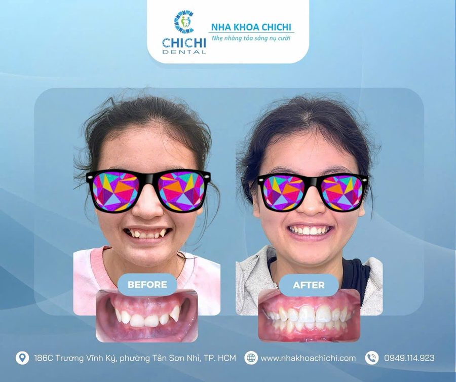 Trước và sau chỉnh nha - Khách hàng 13