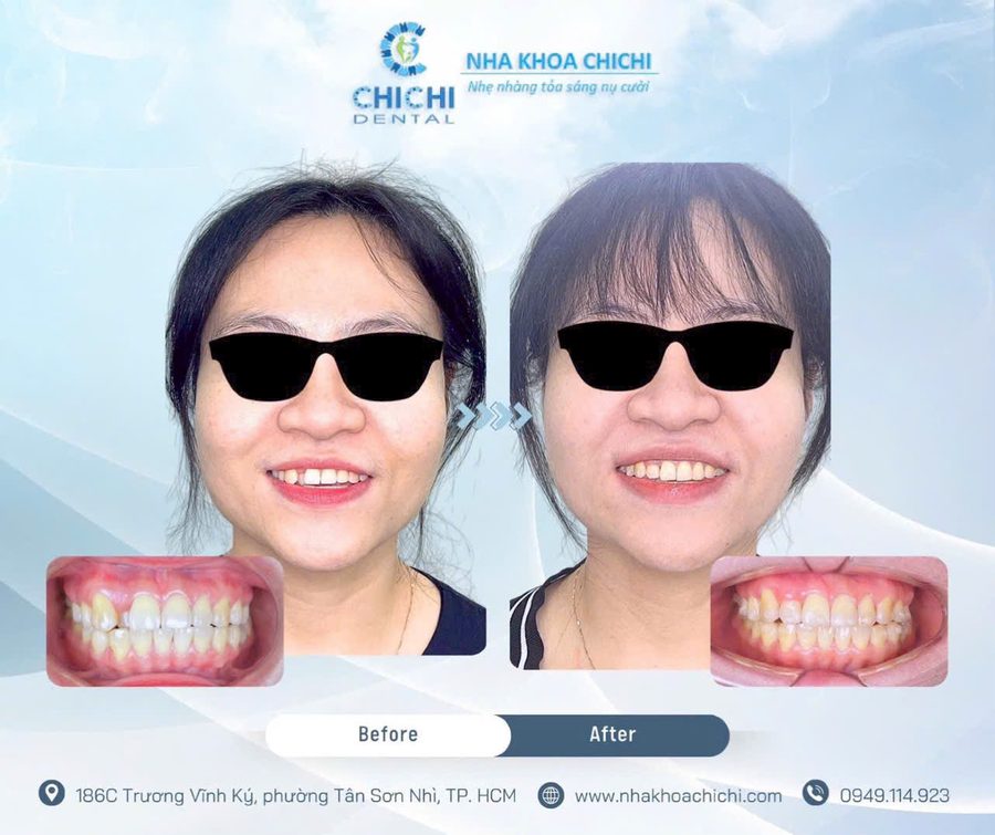 Trước và sau chỉnh nha - Khách hàng 14