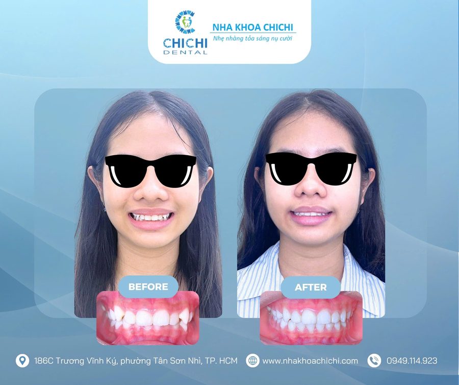 Trước và sau chỉnh nha - Khách hàng 15