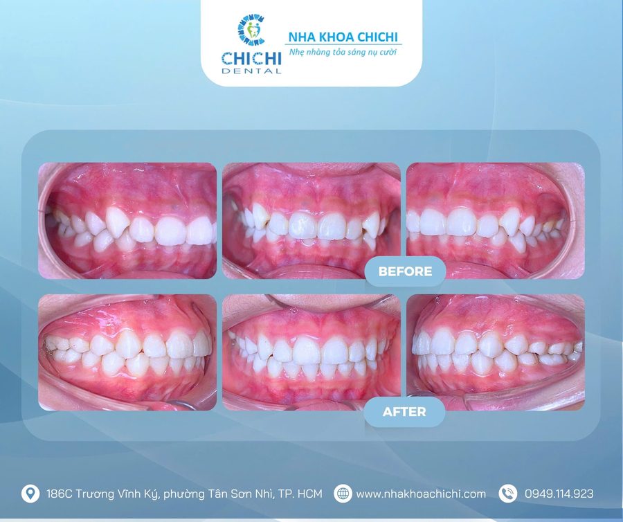 Trước và sau chỉnh nha - Khách hàng 16