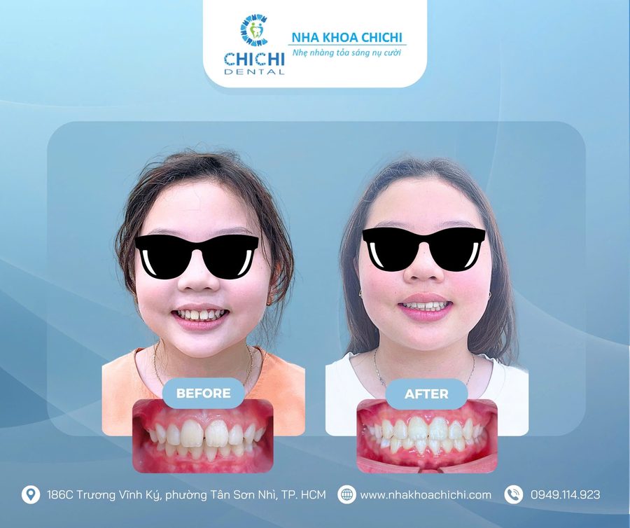 Trước và sau chỉnh nha - Khách hàng 17