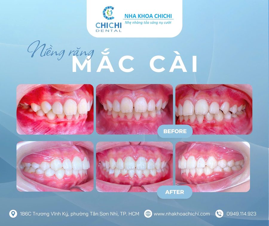 Trước và sau chỉnh nha - Khách hàng 18