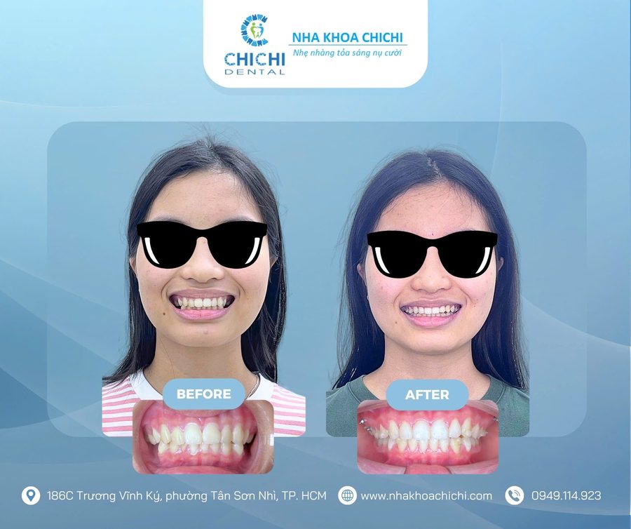 Trước và sau chỉnh nha - Khách hàng 19