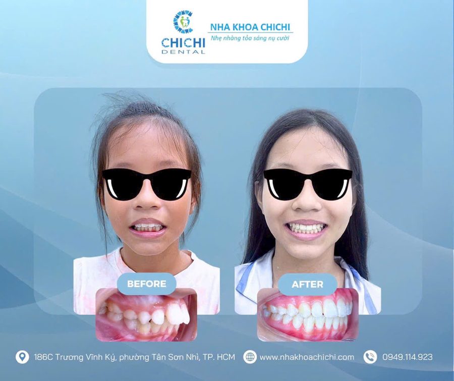 Trước và sau chỉnh nha - Khách hàng 2