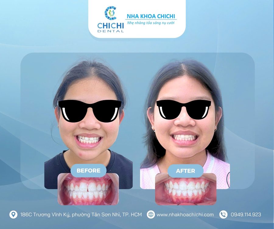 Trước và sau chỉnh nha - Khách hàng 20