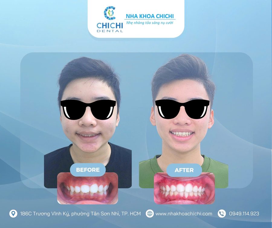 Trước và sau chỉnh nha - Khách hàng 21