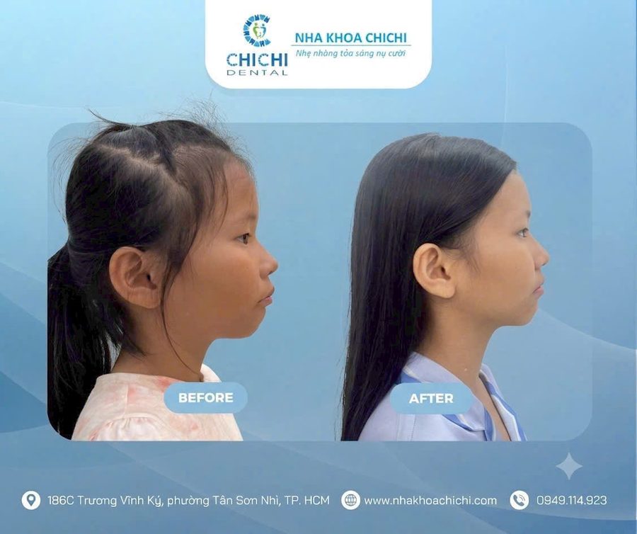 Trước và sau chỉnh nha - Khách hàng 3