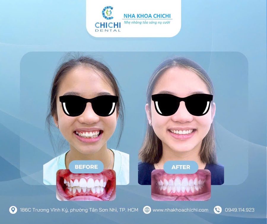 Trước và sau chỉnh nha - Khách hàng 4
