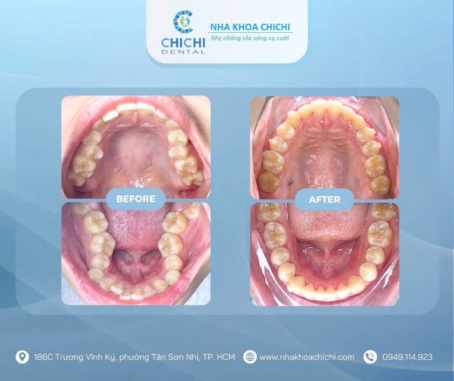 Trước và sau chỉnh nha - Khách hàng 5