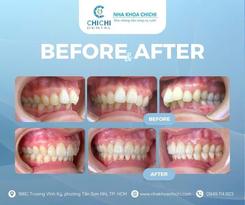 Trước và sau chỉnh nha - Khách hàng 6