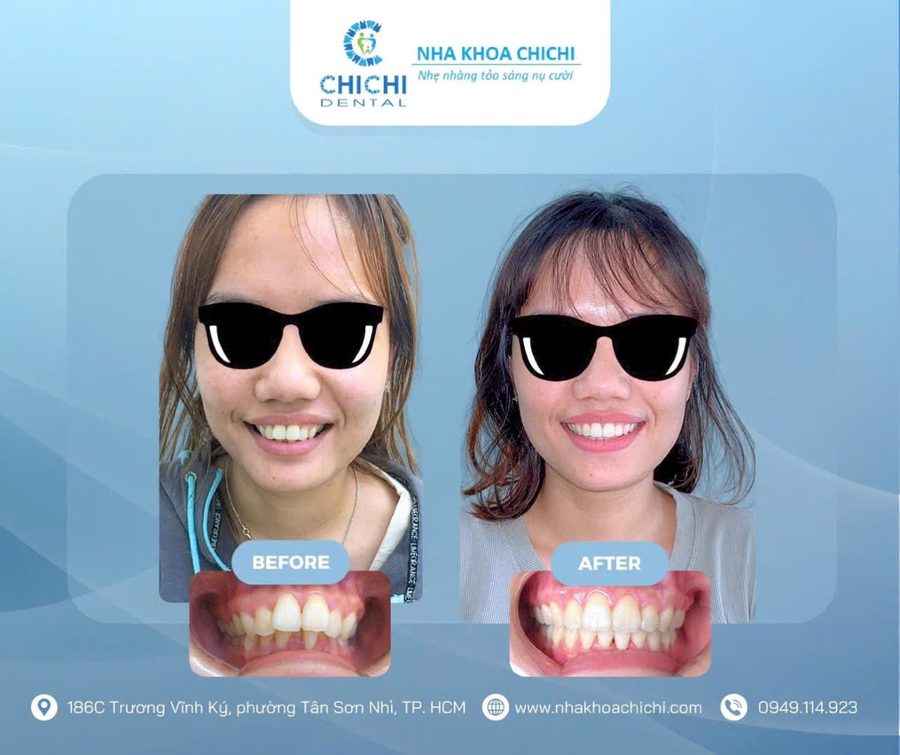 Trước và sau chỉnh nha - Khách hàng 7