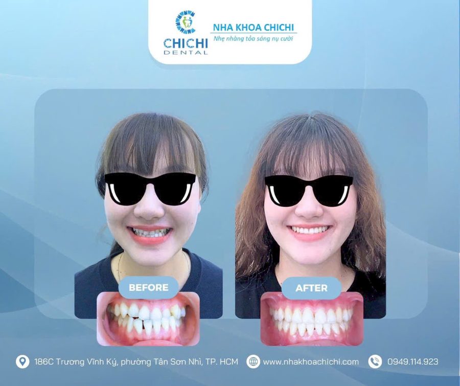 Trước và sau chỉnh nha - Khách hàng 8