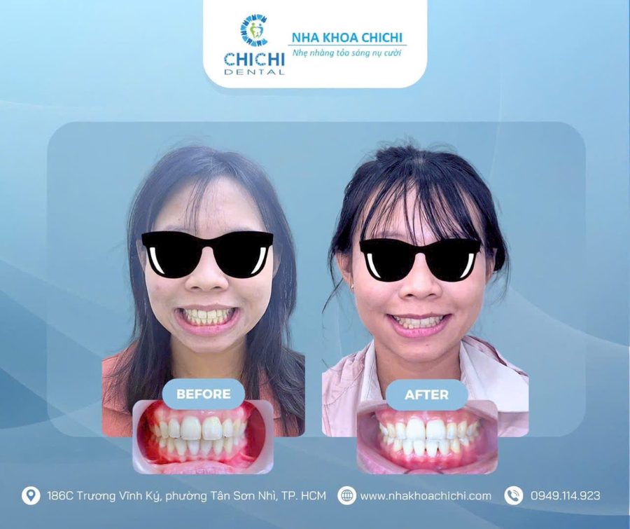 Trước và sau chỉnh nha - Khách hàng 9