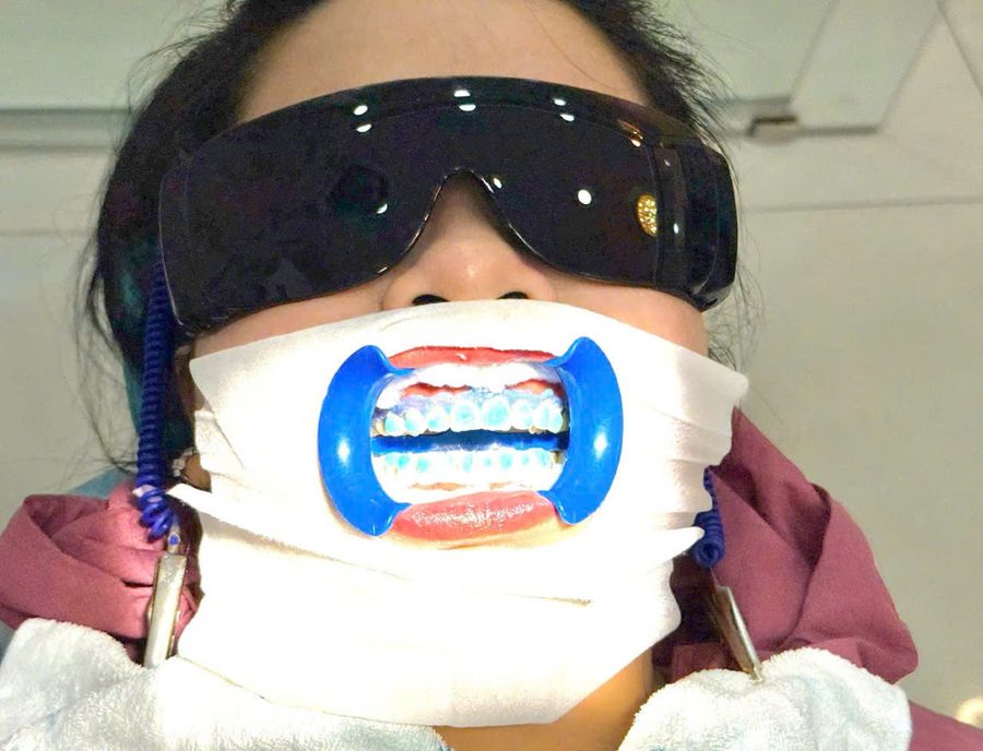 Cận cảnh tẩy trắng răng bằng ánh sáng Laser