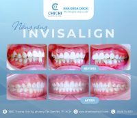 invi-story1